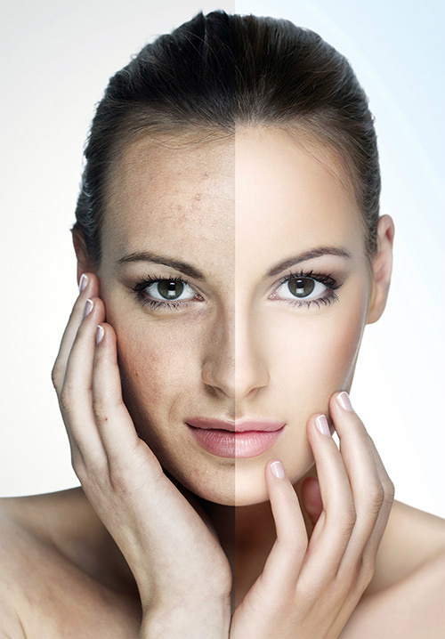 Microdermabrasie | Beautyfabrique | Utrecht